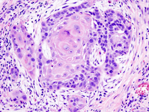 Histo-patologisk billede af et såkaldt pladecellekarcinom i en biopsi