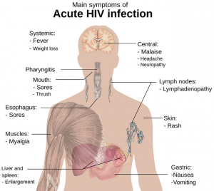 HIV symptoms