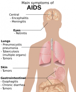 Illustrasjon med symptomer på AIDS